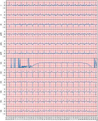 ECGAssess: A Python-Based Toolbox to Assess ECG Lead Signal Quality